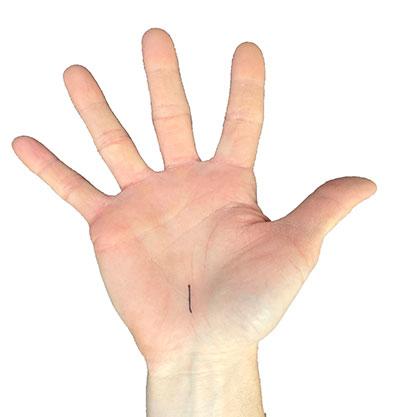 Bild einer Hand mit dem angezeichneten Zugangsweg der Operation eines Karpaltunnelsyndroms